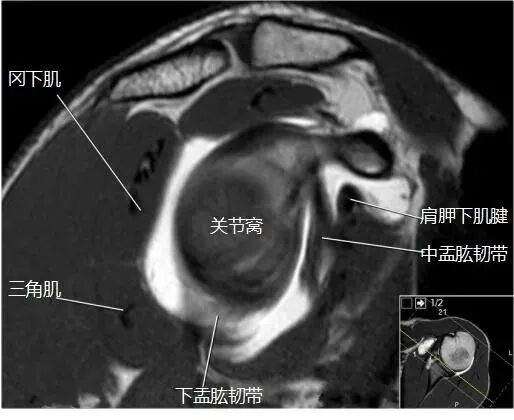 肩关节磁共振（MRI）经典解剖