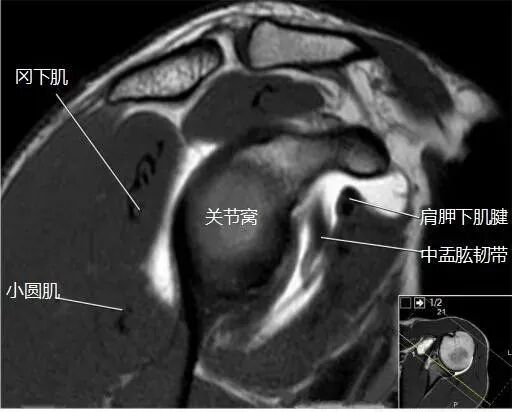 肩关节磁共振（MRI）经典解剖
