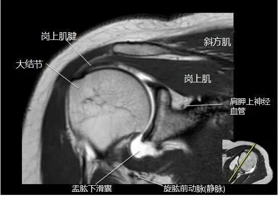 肩关节磁共振（MRI）经典解剖