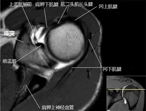 肩关节磁共振（MRI）经典解剖