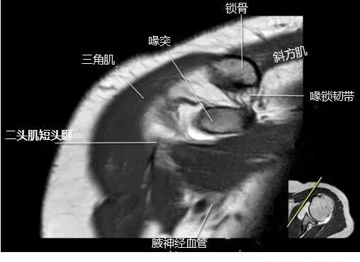 肩关节磁共振（MRI）经典解剖