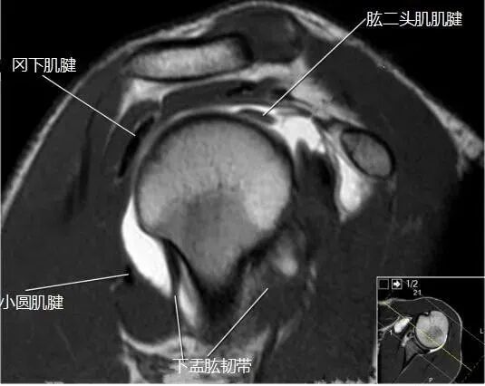 肩关节磁共振（MRI）经典解剖