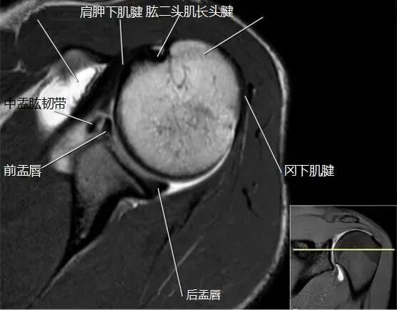 肩关节磁共振（MRI）经典解剖