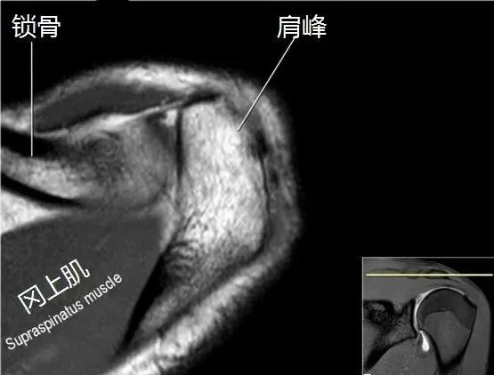 肩关节磁共振（MRI）经典解剖