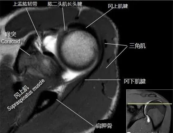 肩关节磁共振（MRI）经典解剖