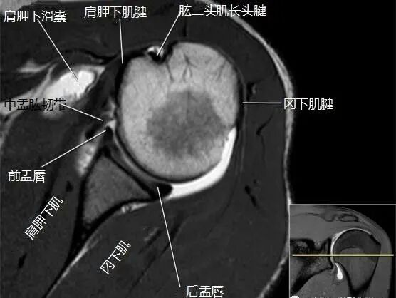 肩关节磁共振（MRI）经典解剖
