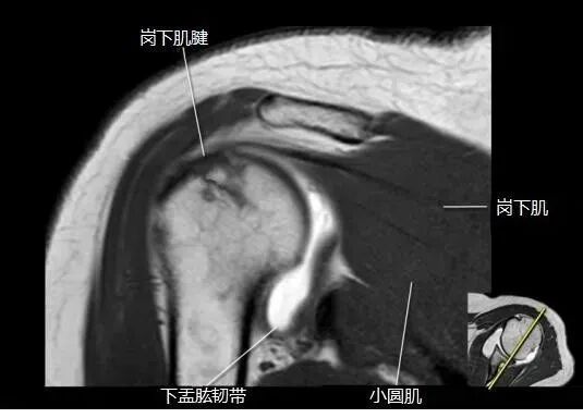 肩关节磁共振（MRI）经典解剖