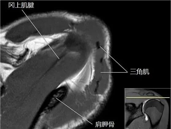 肩关节磁共振（MRI）经典解剖