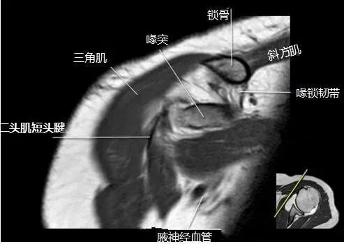 肩关节磁共振（MRI）经典解剖
