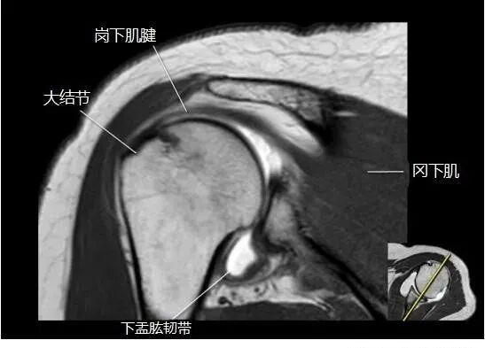 肩关节磁共振（MRI）经典解剖
