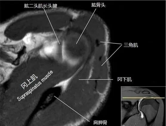 肩关节磁共振（MRI）经典解剖