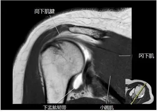 肩关节磁共振（MRI）经典解剖