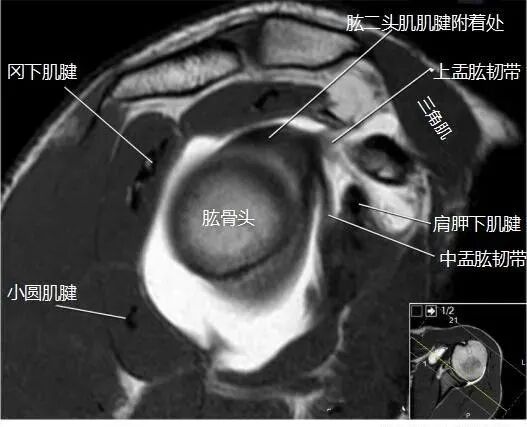 肩关节磁共振（MRI）经典解剖