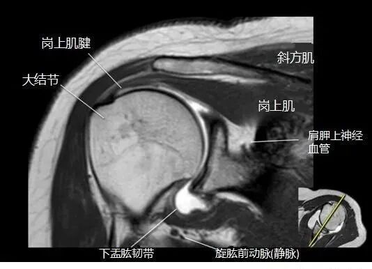 肩关节磁共振（MRI）经典解剖