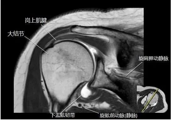 肩关节磁共振（MRI）经典解剖