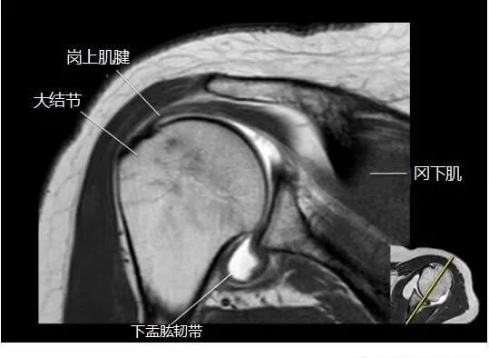 肩关节磁共振（MRI）经典解剖