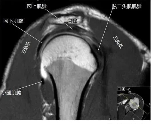 肩关节磁共振（MRI）经典解剖