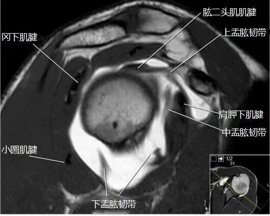 肩关节磁共振（MRI）经典解剖