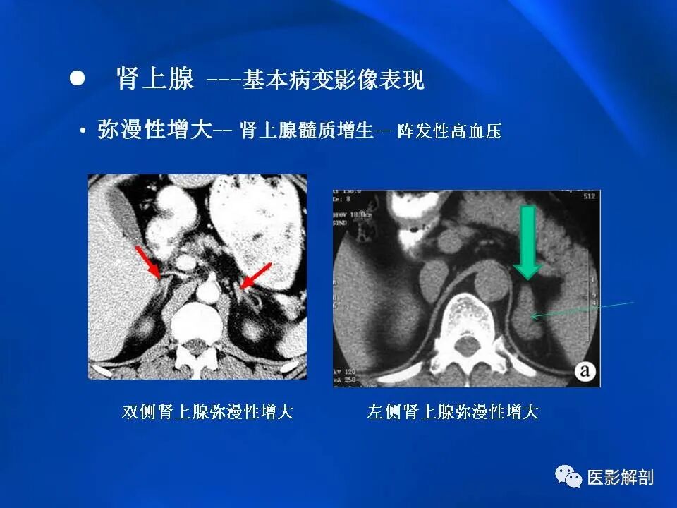 肾上腺解剖及相关病变的影像诊断_医学界-助力医生临床决策和职业成长