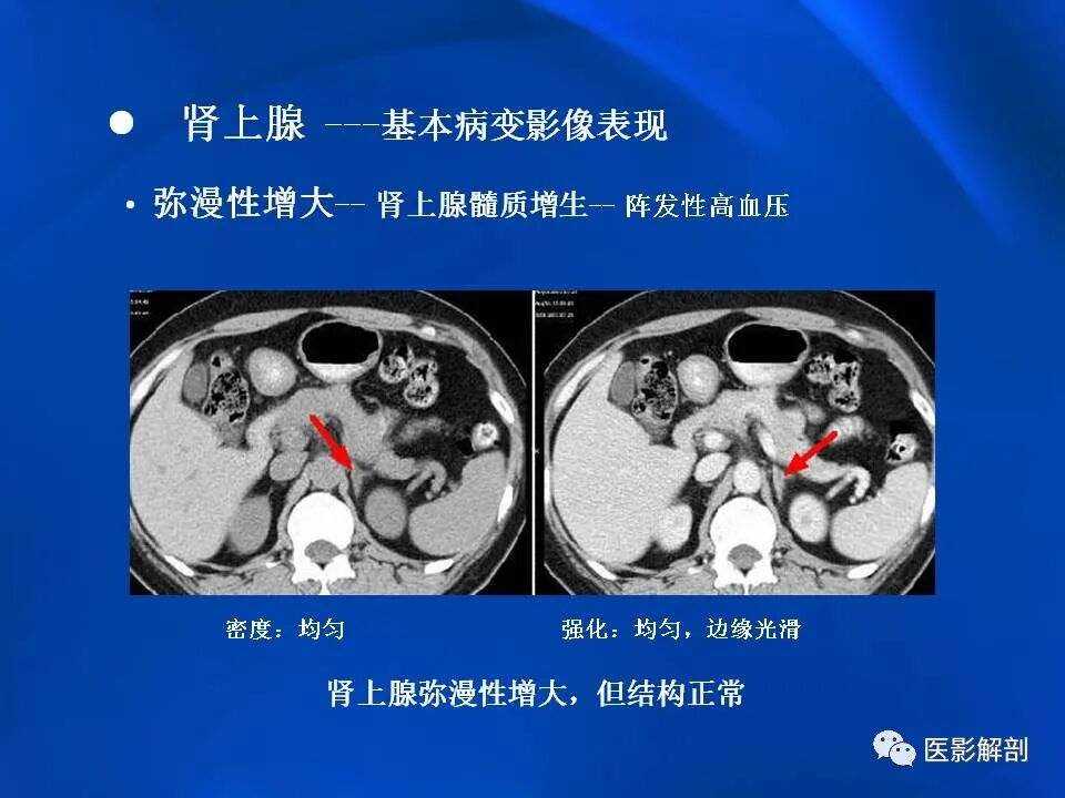 肾上腺解剖及相关病变的影像诊断_医学界-助力医生临床决策和职业成长