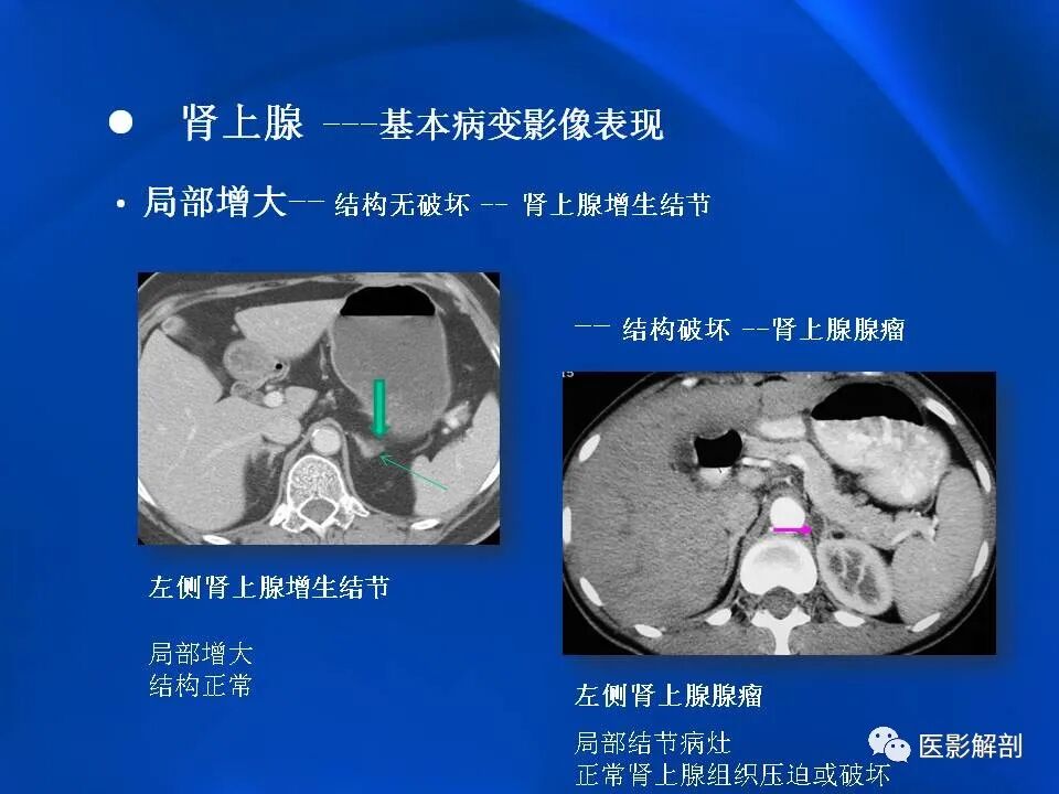 肾上腺解剖及相关病变的影像诊断_医学界-助力医生临床决策和职业成长