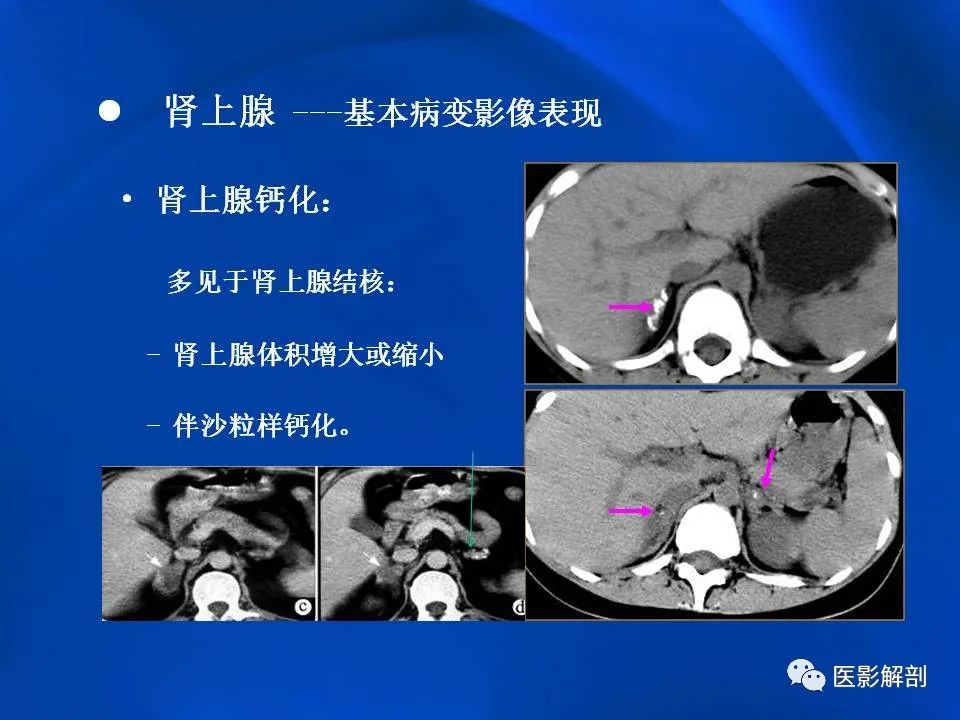 肾上腺解剖及相关病变的影像诊断