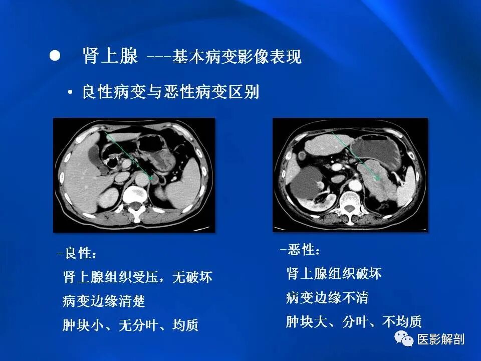 肾上腺解剖及相关病变的影像诊断_医学界-助力医生临床决策和职业成长