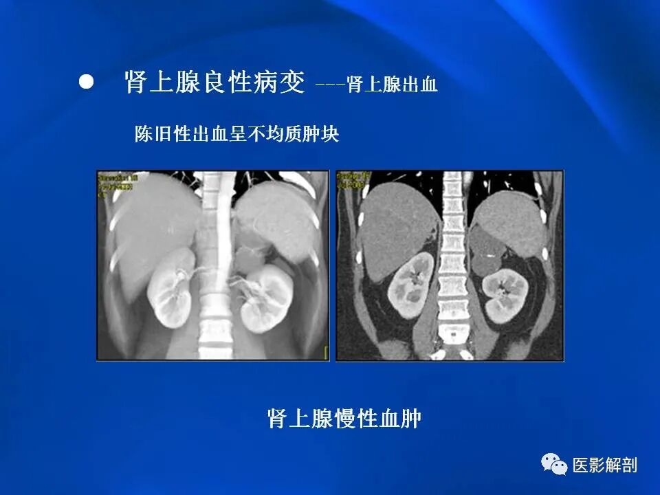 肾上腺解剖及相关病变的影像诊断_医学界-助力医生临床决策和职业成长