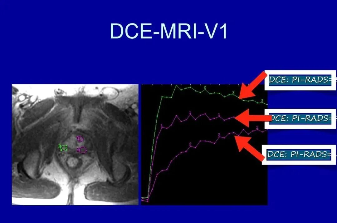 前列腺解剖及mri表现
