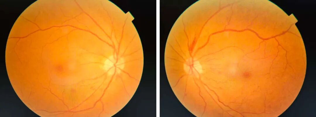 怎么躲过散瞳机一眼见底，洞察秋毫——我院眼耳鼻喉咽喉科新引进免散瞳眼底相机_https://www.jmylbn.com_新闻资讯_第3张