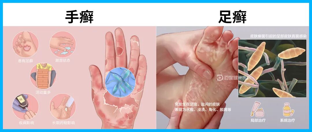 手足癣不仅瘙痒难耐，为何多数人选择冬季治疗？