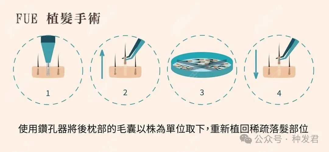 深圳正规植发医院的费用多少？做女性发际线种植哪家医院更好？