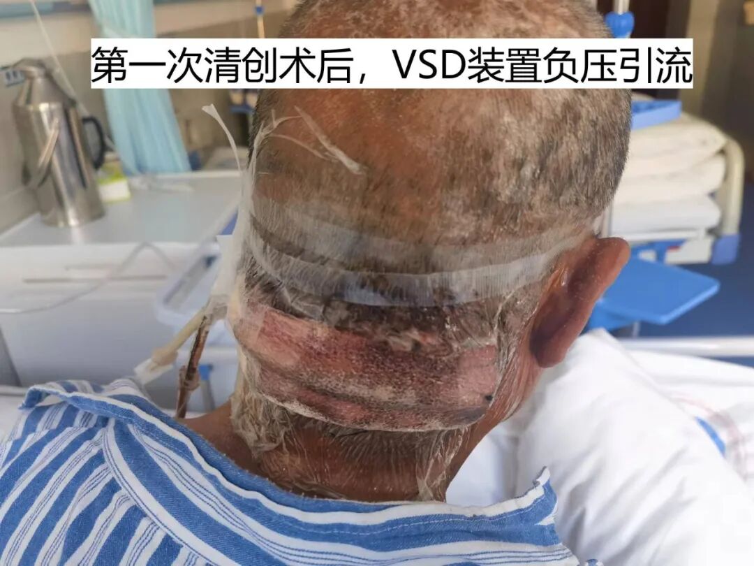 为什么负压引流普洱市人民医院镇沅院区开展创面负压引流术（VSD），让创面更快痊愈！_https://www.jmylbn.com_新闻资讯_第6张