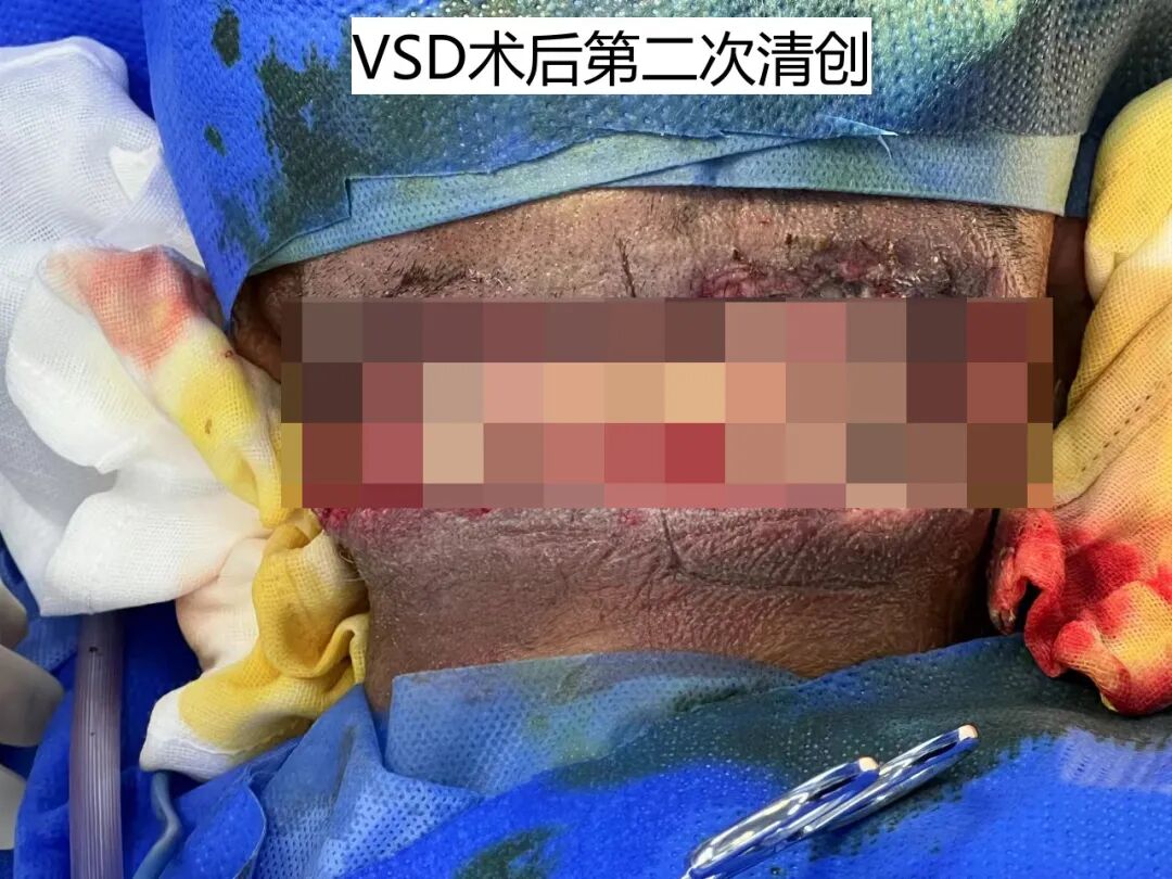 为什么负压引流普洱市人民医院镇沅院区开展创面负压引流术（VSD），让创面更快痊愈！_https://www.jmylbn.com_新闻资讯_第7张