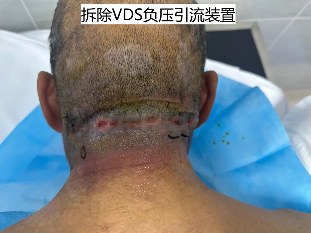 为什么负压引流普洱市人民医院镇沅院区开展创面负压引流术（VSD），让创面更快痊愈！_https://www.jmylbn.com_新闻资讯_第8张