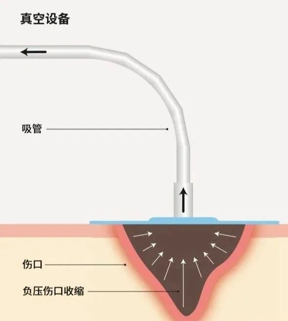 为什么负压引流普洱市人民医院镇沅院区开展创面负压引流术（VSD），让创面更快痊愈！_https://www.jmylbn.com_新闻资讯_第9张