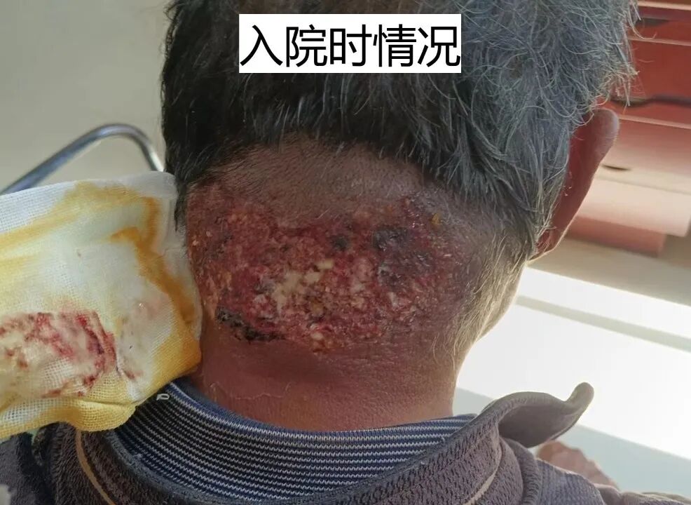 为什么负压引流普洱市人民医院镇沅院区开展创面负压引流术（VSD），让创面更快痊愈！_https://www.jmylbn.com_新闻资讯_第5张