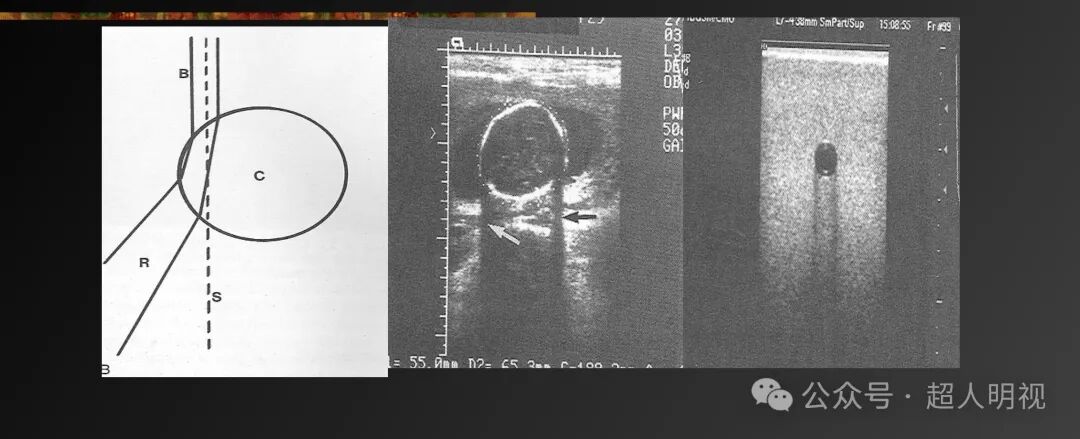 彩超伪像是什么超声伪像_https://www.jmylbn.com_新闻资讯_第4张