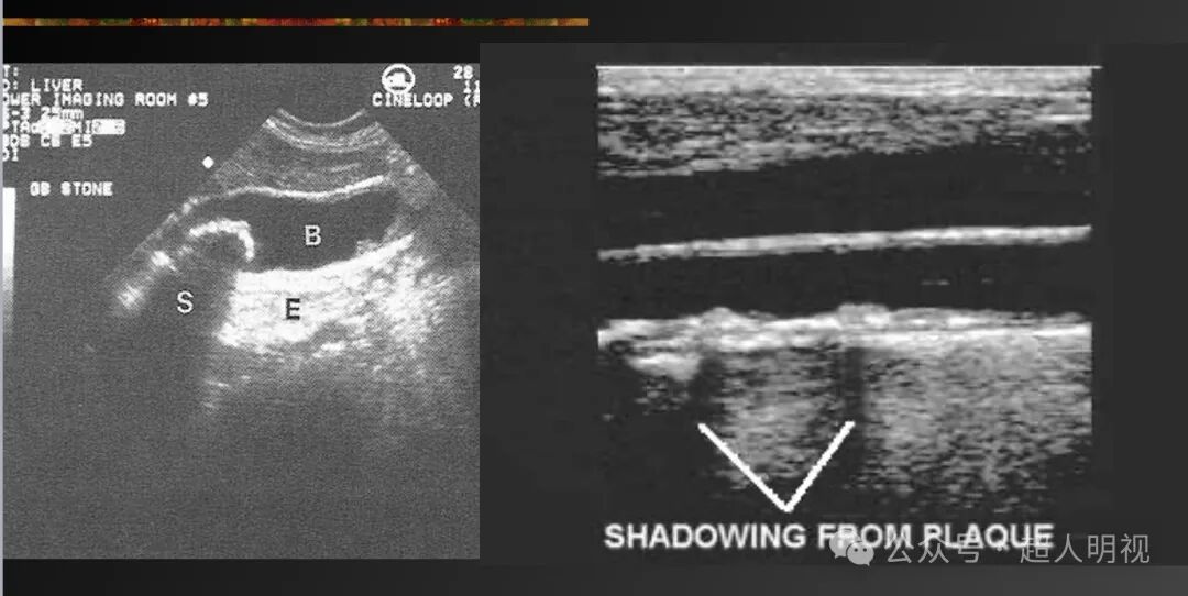 彩超伪像是什么超声伪像_https://www.jmylbn.com_新闻资讯_第3张