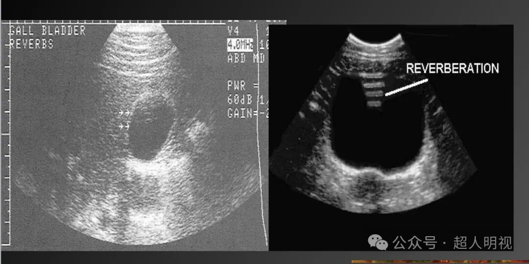 彩超伪像是什么超声伪像_https://www.jmylbn.com_新闻资讯_第6张