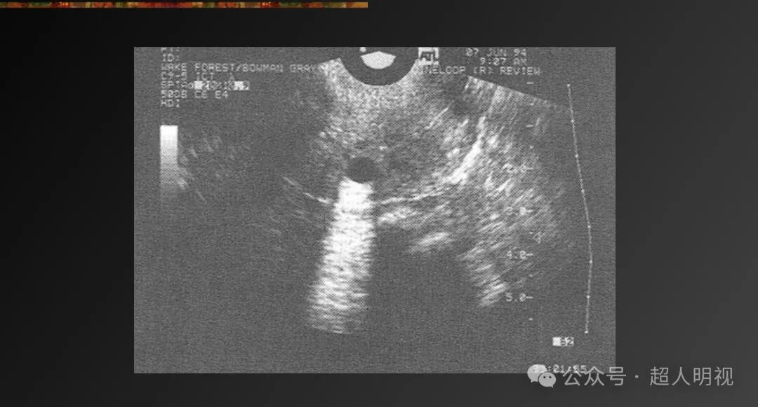 彩超伪像是什么超声伪像_https://www.jmylbn.com_新闻资讯_第5张