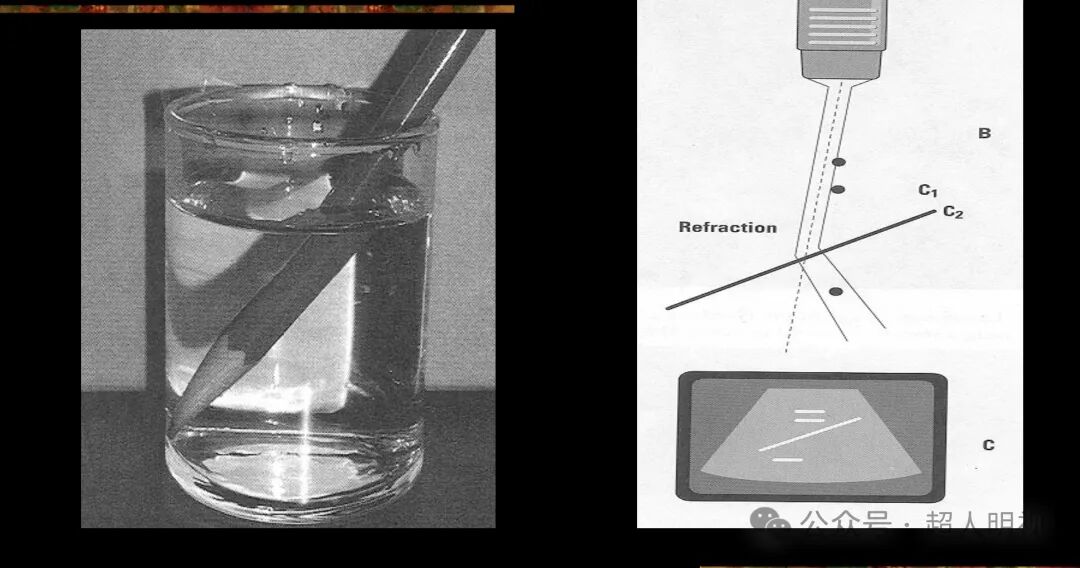 彩超伪像是什么超声伪像_https://www.jmylbn.com_新闻资讯_第8张