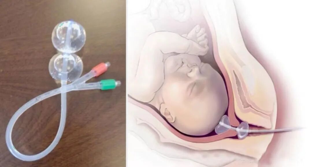 子宫颈扩张球囊是什么提高正常分娩的好方法——宫颈扩张球囊_https://www.jmylbn.com_新闻资讯_第2张