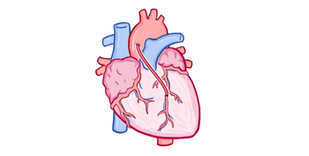 急性冠状动脉综合征，临床必备！
