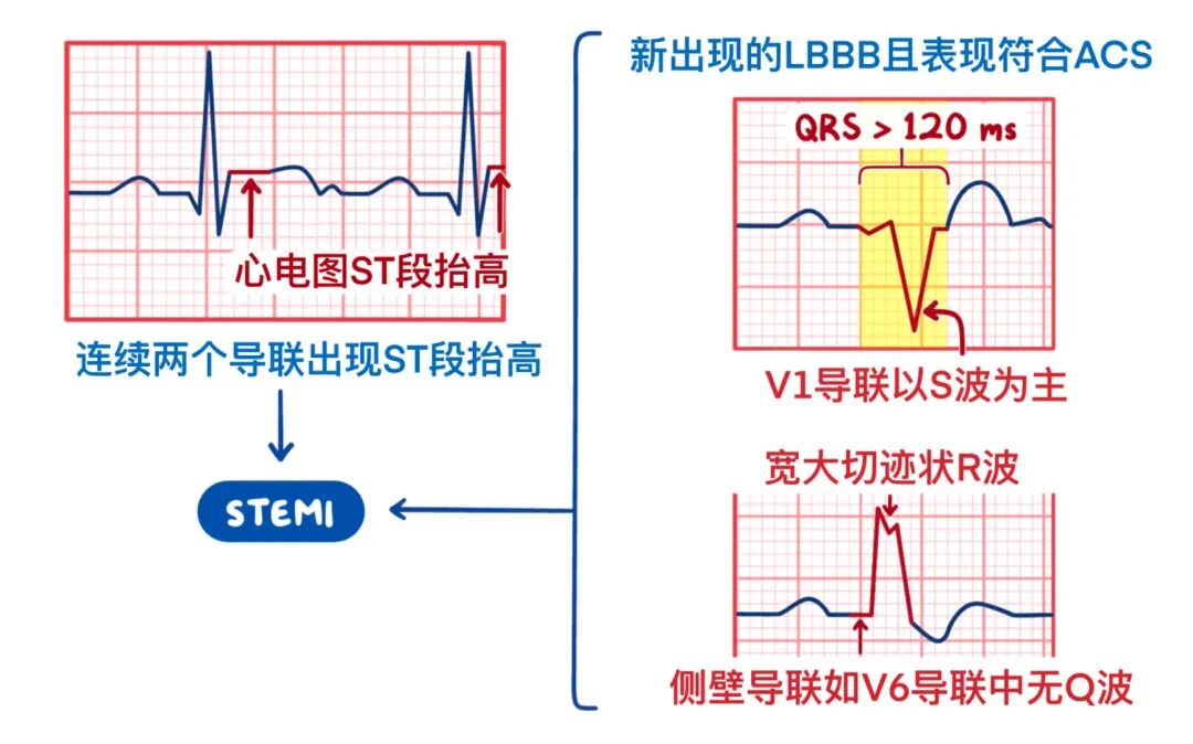 急性冠状动脉综合征，临床必备！
