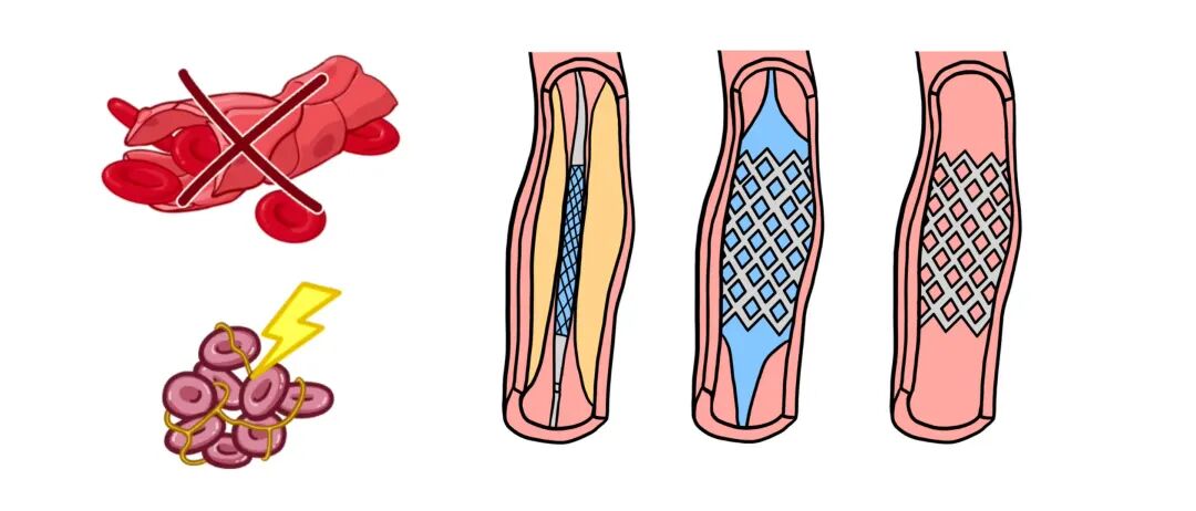 急性冠状动脉综合征，临床必备！