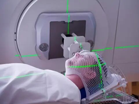 放疗做膜是什么意思【健康科普】放疗那些事_https://www.jmylbn.com_新闻资讯_第3张