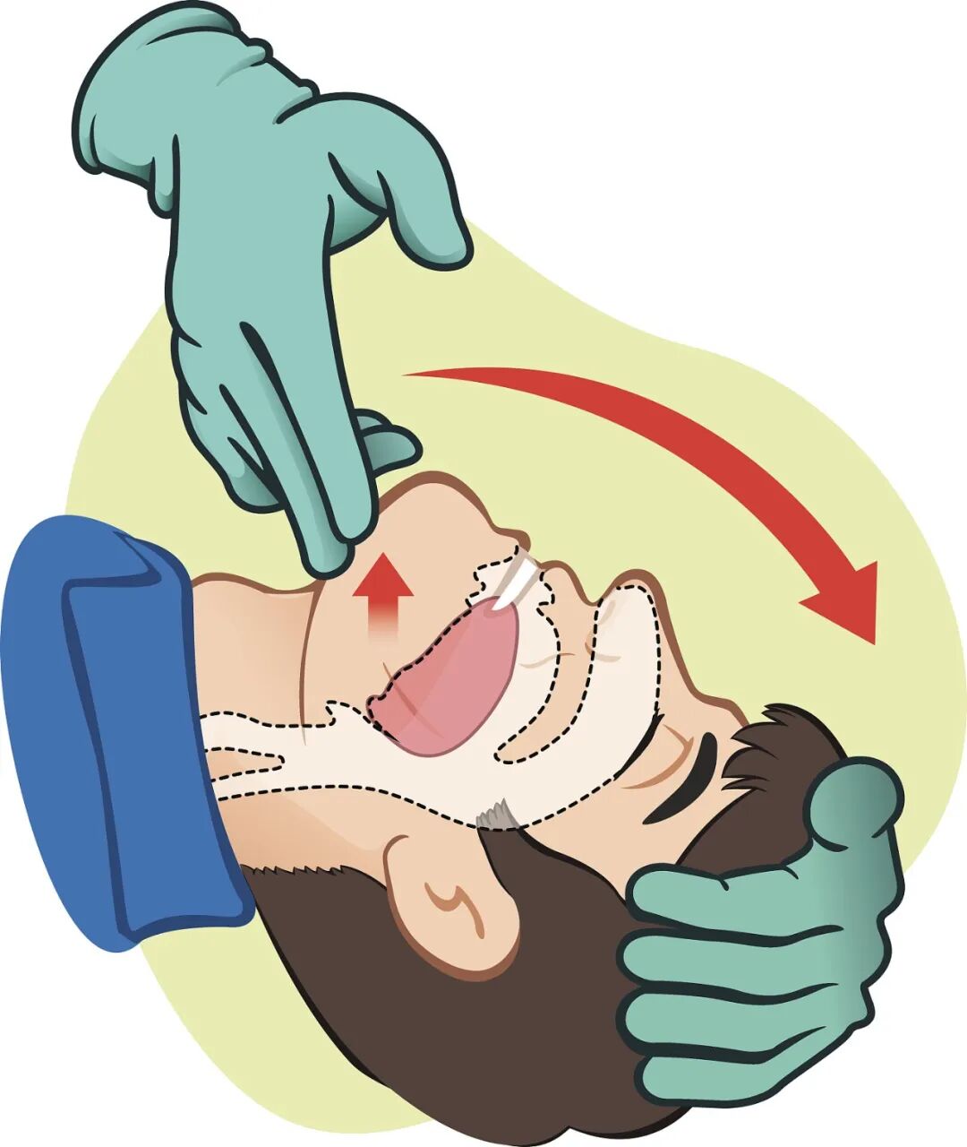 cpr按压板怎么放置【健康之窗】急救科普 ｜ 心肺复苏（CPR）全攻略_https://www.jmylbn.com_新闻资讯_第34张