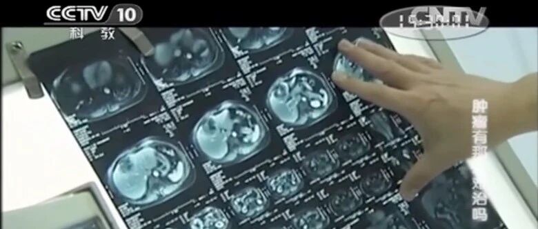 峰回路转，免疫细胞疗法让她重获新生！