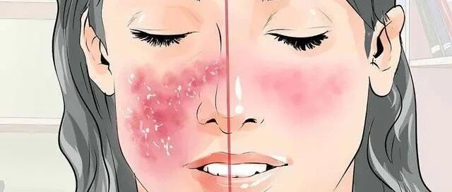 干细胞疗法治疗红斑狼疮，可改善疾病活性、蛋白尿和低复合血症。